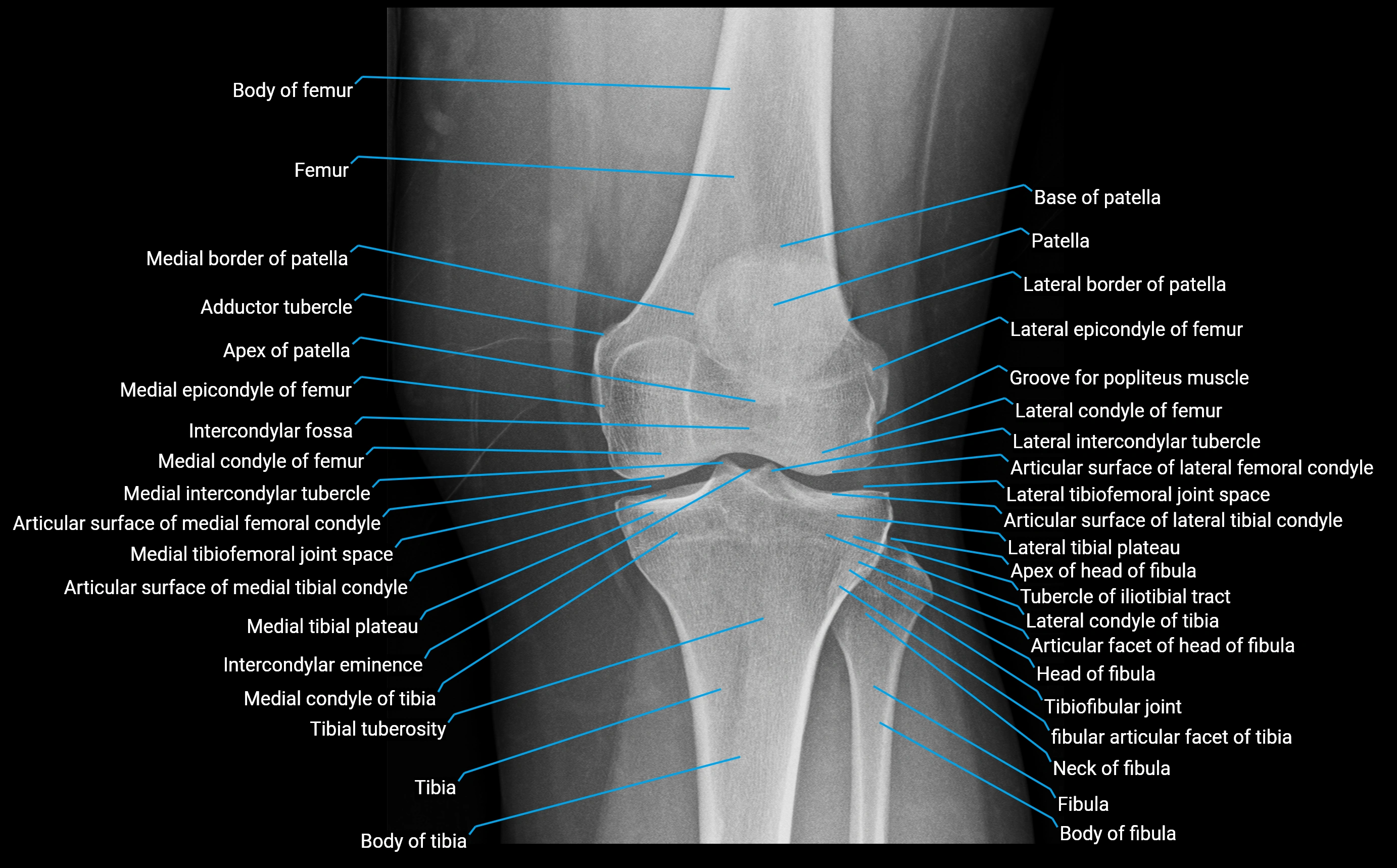 X Ray knee AP anatomy labelled.webp